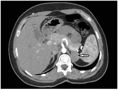 Adrenal adenoma secreting 17-hydroxyprogesterone mimicking non-classical 21-hydroxylase deficiency